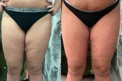 1_mastersculpt-infrashape-kezeles-eredmeny