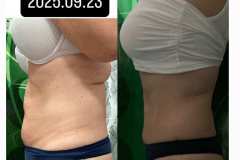 35-alakformalas-eredmeny-Mastersculpt-lipolezer-kezeles