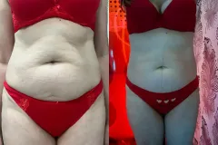 Alakformalas-eredmeny-MasterSculpt-es-InfraShape-11