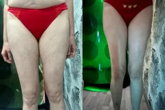 Alakformalas-eredmeny-MasterSculpt-es-InfraShape-12