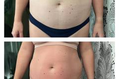 Infrashape-1-het-kezeles-utan-EMSHifu