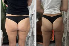 Infrashape-EMS-kezeles