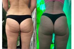 Infrashape-kezeles-eredmeny-14-Mastersculpt-liolezer