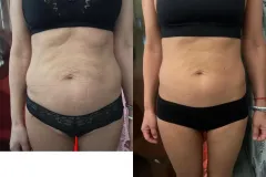 MasterSculpt-lipolezer-es-MONOSCULPT-zsirszovetcsokkentes-borfeszesitessel-kombinalva