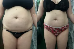 Mastersculpt-es-Infrashape-kombo-kezeles-1100x842