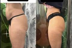 Mastersculpt-lipolezer-fenekemeles-alakformalas-2026-0402-1