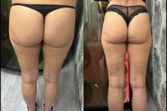 Mastersculpt-lipolezer-fenekemeles-alakformalas-2026-0402-2