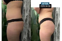 Mastersculpt-lipolezer-fenekemeles-alakformalas-2026-0408-1