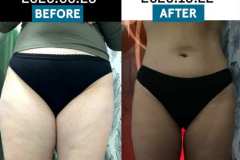 infrashape-35-kezeles-eredmeny-mastersculptcryoinfrashape-tobb-honap-2