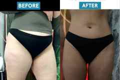 infrashape-35-kezeles-eredmeny-mastersculptcryoinfrashape-tobb-honap