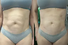 infrashape-web-21-mastersculpt-lipolezer-alakformalas-eredmeny-3-het