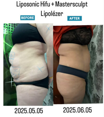 Liposonic Hifu kúrakezelések 11