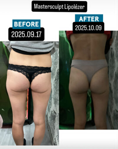 MasterSculpt Hiemt lipolézer kúrakezelések 17