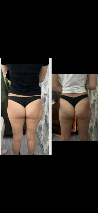 MasterSculpt Hiemt lipolézer kúrakezelések 27