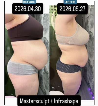 MasterSculpt Hiemt lipolézer kúrakezelések 29