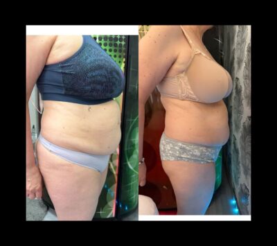 MasterSculpt Infrashape kúrakezelések 32